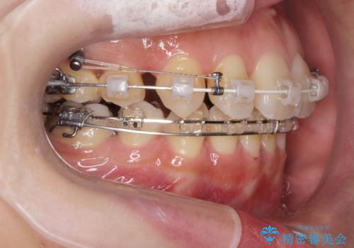 八重歯を矯正治療で治したい!の治療中