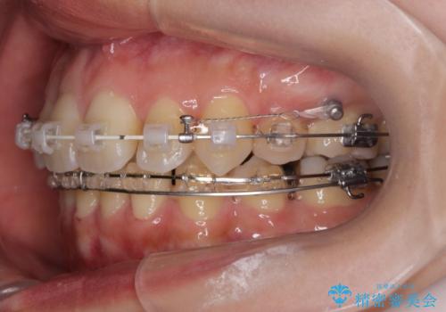 八重歯を矯正治療で治したい!の治療中
