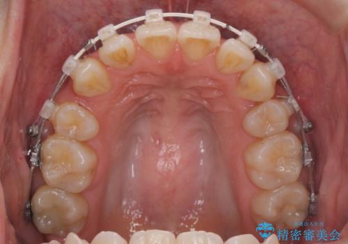 八重歯を矯正治療で治したい!の治療中