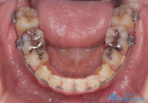 八重歯を矯正治療で治したい!の治療中