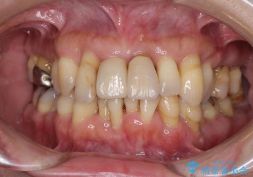 歯周病でグラグラの歯 矯正治療と歯周外科を併用した総合歯科治療の症例 治療前