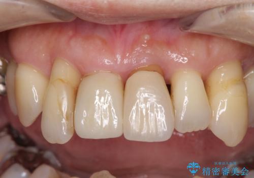 歯周病でグラグラの歯 矯正治療と歯周外科を併用した総合歯科治療の治療前