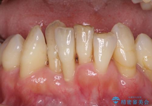 歯周病でグラグラの歯 矯正治療と歯周外科を併用した総合歯科治療の治療前