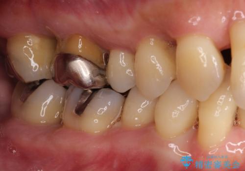 歯周病でグラグラの歯 矯正治療と歯周外科を併用した総合歯科治療の治療前