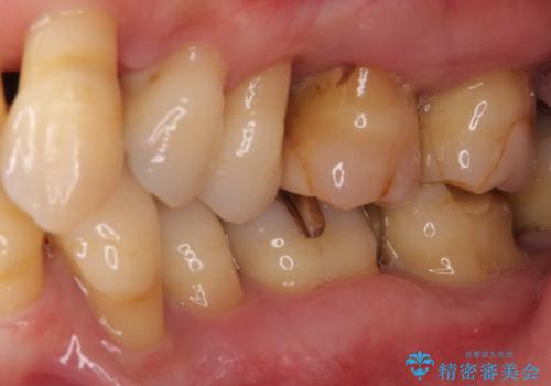 歯周病でグラグラの歯 矯正治療と歯周外科を併用した総合歯科治療の治療前