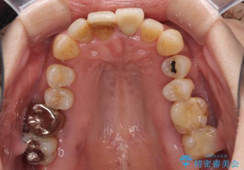 歯周病でグラグラの歯 矯正治療と歯周外科を併用した総合歯科治療の治療前