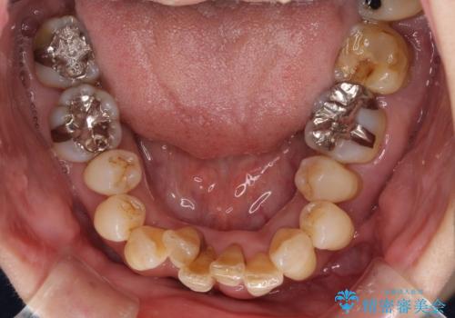 歯周病でグラグラの歯 矯正治療と歯周外科を併用した総合歯科治療の治療前