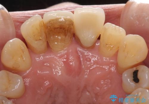 歯周病でグラグラの歯 矯正治療と歯周外科を併用した総合歯科治療の治療前