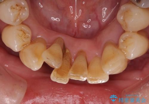 歯周病でグラグラの歯 矯正治療と歯周外科を併用した総合歯科治療の治療前