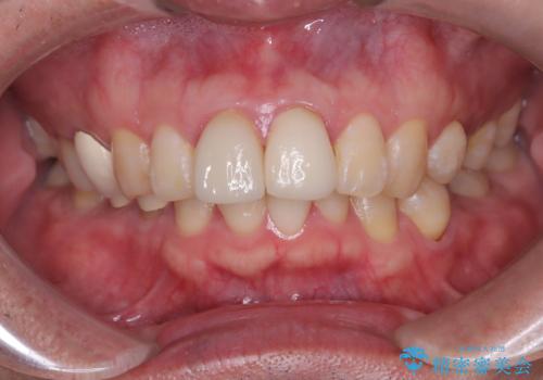 前歯の根のところに違和感がある|根尖性歯周炎|精密根管治療|オールセラミッククラウン|見た目も改善の治療前