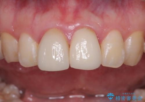 前歯の根のところに違和感がある|根尖性歯周炎|精密根管治療|オールセラミッククラウン|見た目も改善の治療前