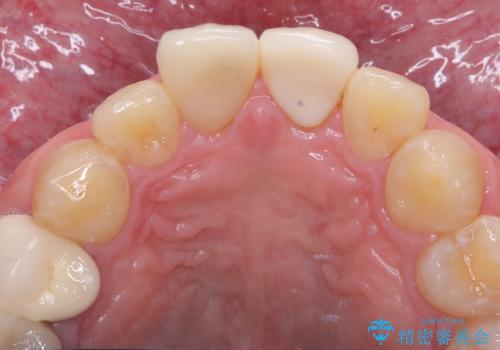 前歯の根のところに違和感がある|根尖性歯周炎|精密根管治療|オールセラミッククラウン|見た目も改善の治療前