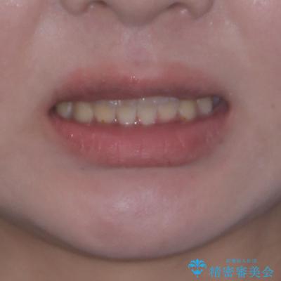 転位歯や埋伏歯などの難易度の高い抜歯矯正治療の治療後(顔貌)