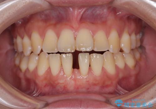 矯正の後戻りによるすきっ歯と歯肉退縮 根面被覆と部分矯正の治療中