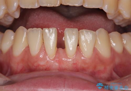 矯正の後戻りによるすきっ歯と歯肉退縮 根面被覆と部分矯正の治療中