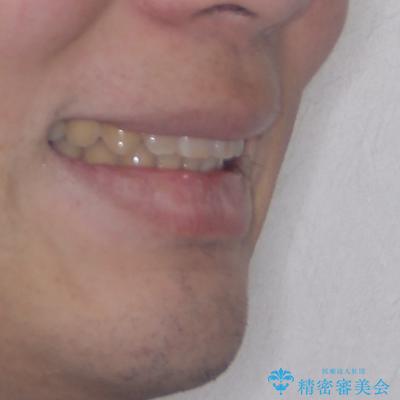 上顎前歯のデコボコを改善してスッキリした口元に ワイヤー装置での非抜歯矯正の治療後(顔貌)