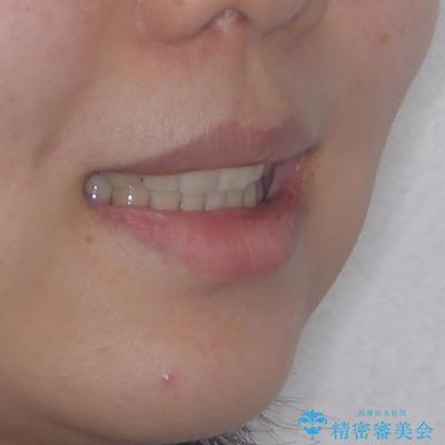 欠損と口元の突出感 ワイヤー装置での抜歯矯正の治療後(顔貌)