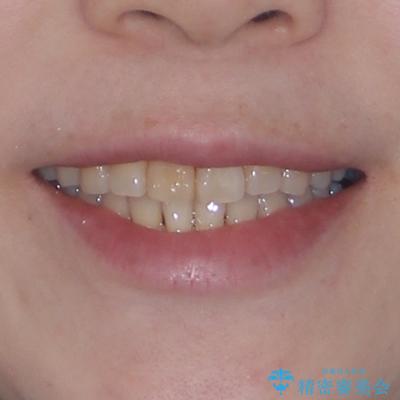 前歯のデコボコをインビザライン・モデレートで矯正治療の治療後(顔貌)