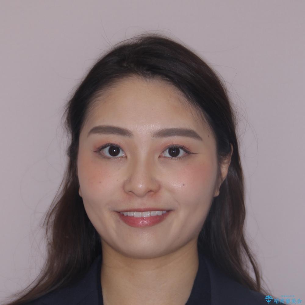 【モニター】八重歯と正中を改善 ワイヤー装置の抜歯矯正の治療後(顔貌)