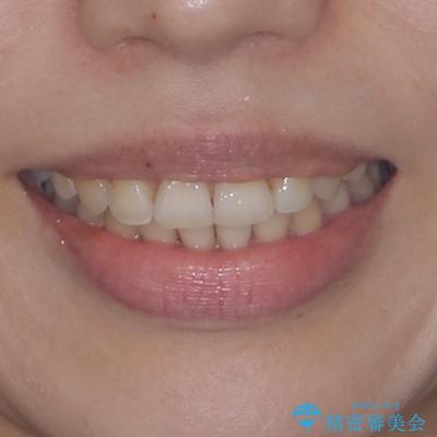 インビザライン・モデレートを用いて気になる後戻りを矯正治療の治療後(顔貌)