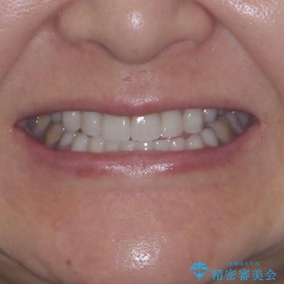 外れるブリッジと気になる八重歯 総合歯科治療で美しい口元にの治療後(顔貌)