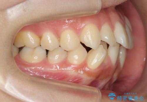 八重歯を矯正治療で治したい!の治療前