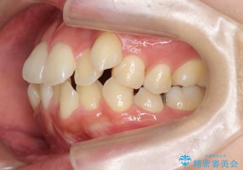 八重歯を矯正治療で治したい!の治療前