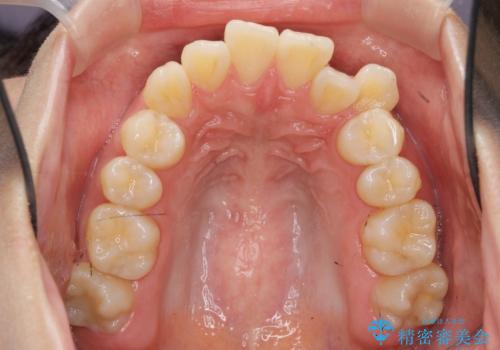 八重歯を矯正治療で治したい!の治療前