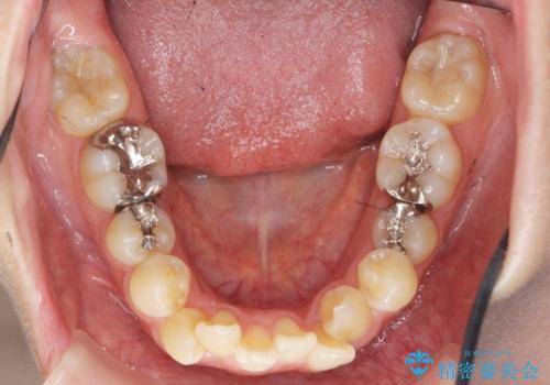 八重歯を矯正治療で治したい!の治療前