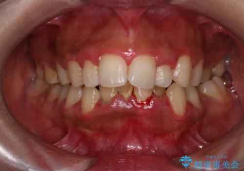 前歯の出っ張りとガタつきを改善