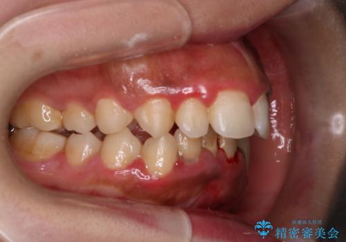 前歯の出っ張りとガタつきを改善の治療前