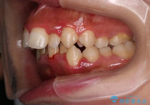 前歯の出っ張りとガタつきを改善の治療前