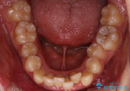 前歯の出っ張りとガタつきを改善の治療前