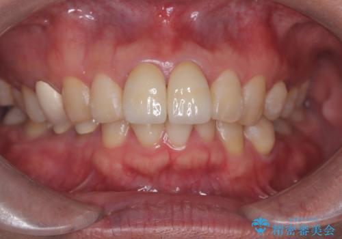前歯の根のところに違和感がある|根尖性歯周炎|精密根管治療|オールセラミッククラウン|見た目も改善の治療後