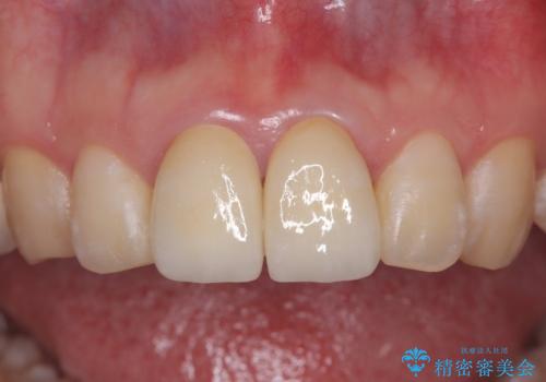 前歯の根のところに違和感がある|根尖性歯周炎|精密根管治療|オールセラミッククラウン|見た目も改善の治療後