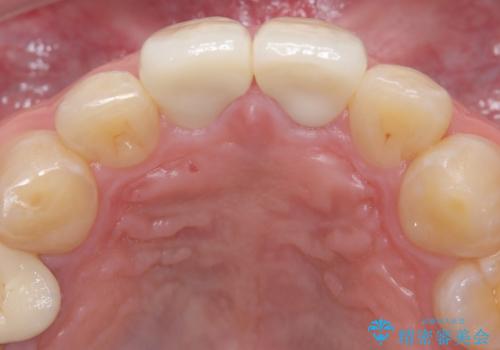 前歯の根のところに違和感がある|根尖性歯周炎|精密根管治療|オールセラミッククラウン|見た目も改善の治療後
