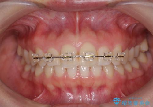 出っ歯に見える前歯の改善 部分ワイヤーとマウスピース矯正の治療前