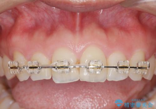 出っ歯に見える前歯の改善 部分ワイヤーとマウスピース矯正の治療前