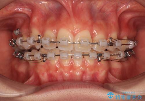 奥歯の咬み合わせのズレと前歯の突出感 変則的な抜歯矯正の治療中