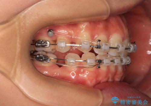 奥歯の咬み合わせのズレと前歯の突出感 変則的な抜歯矯正の治療中