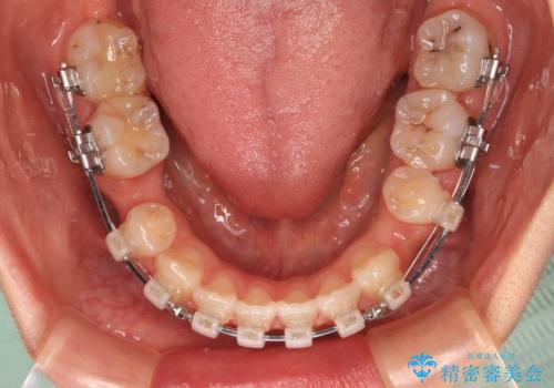 奥歯の咬み合わせのズレと前歯の突出感 変則的な抜歯矯正の治療中