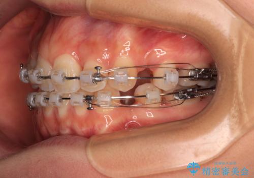 奥歯の咬み合わせのズレと前歯の突出感 変則的な抜歯矯正の治療中