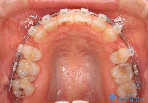奥歯の咬み合わせのズレと前歯の突出感 変則的な抜歯矯正の治療中