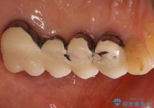 ツギハギの被せ物をキレイなセラミックへの治療前