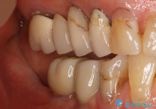 ツギハギの被せ物をキレイなセラミックへの治療前