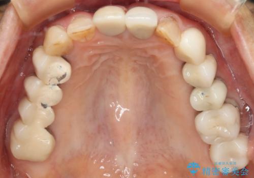 ツギハギの被せ物をキレイなセラミックへの症例 治療前