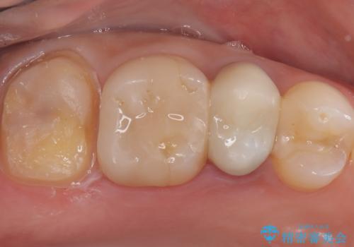 詰め物が欠けた 〈セラミッククラウン〉の治療中