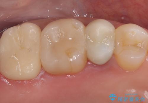 詰め物が欠けた 〈セラミッククラウン〉の症例 治療後