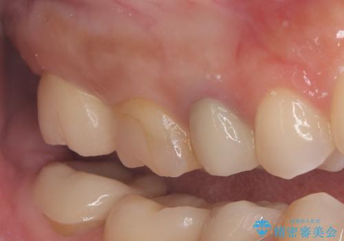 詰め物が欠けた 〈セラミッククラウン〉の治療後