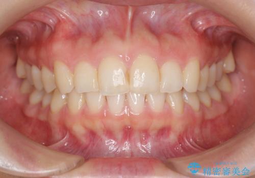 出っ歯に見える前歯の改善 部分ワイヤーとマウスピース矯正の治療中